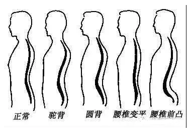 腰椎曲度 腰椎曲度
